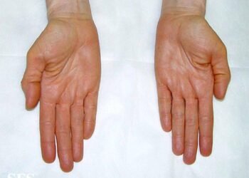 article river 09d4a430aa3511e9b5bebf7f02b753d7 carotenemia palms resized