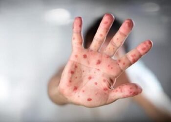 Ilustrasi gejala campak sebagai ancaman kesehatan yang serius (Sumber: rssoemani)