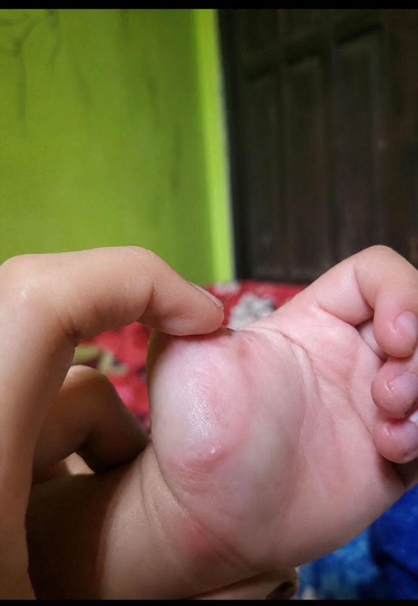 Infeksi Cacing Parasit