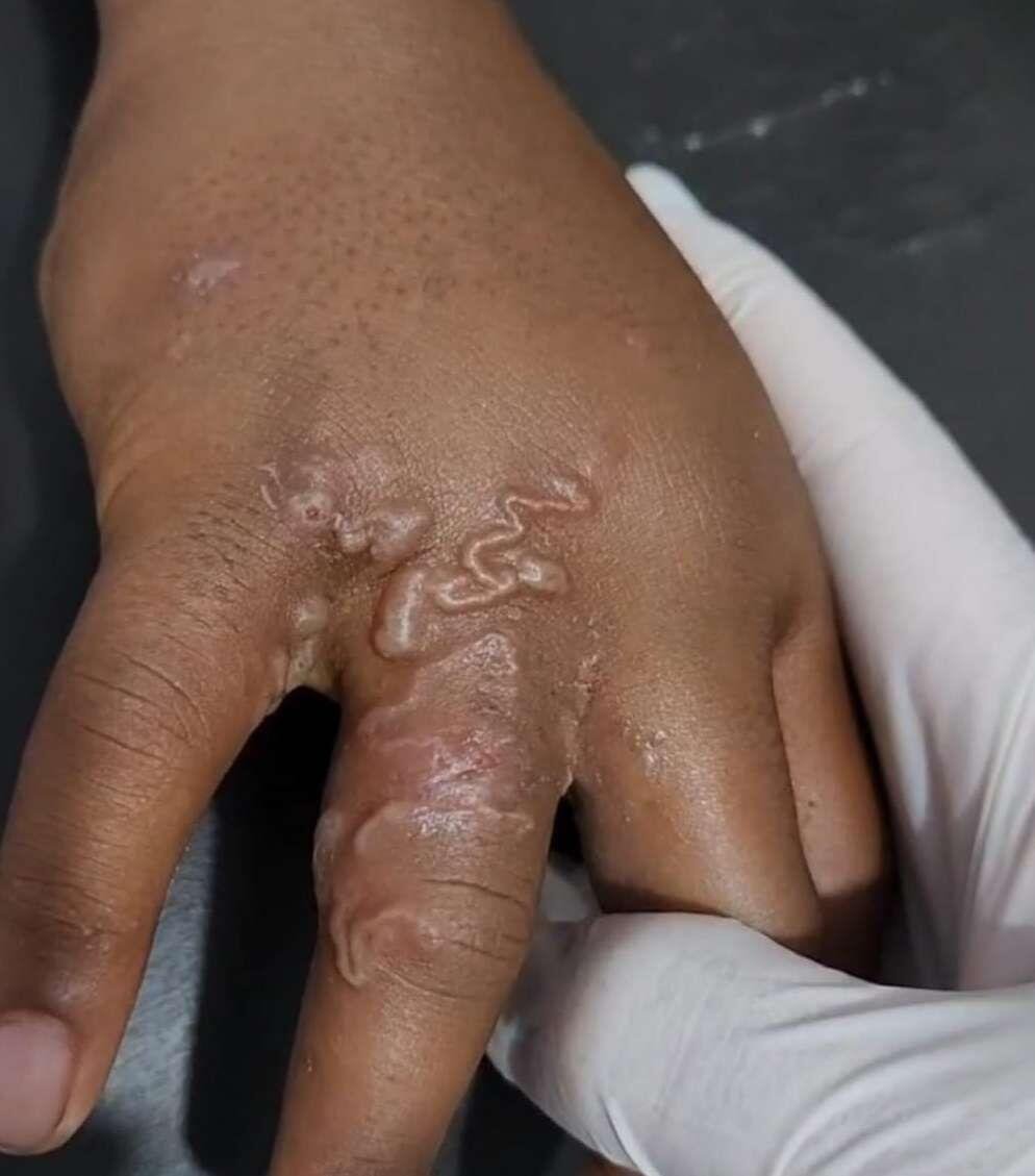 Infeksi Cacing Parasit