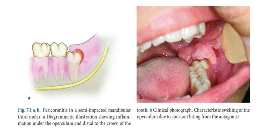 Ketika Gigi Bungsu Tak Punya Tempat: Mengenal Bahaya Gigi Impaksi 47 Gambaran pembengkakan jaringan gusi yang menutupi sebagian gigi bungsu (Sumber: Fragiskos Oral Surgery)