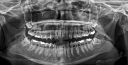 Ketika Gigi Bungsu Tak Punya Tempat: Mengenal Bahaya Gigi Impaksi 48 Gambaran pemeriksaan foto rontgen panoramik (Sumber: Fragiskos Oral Surgery)
