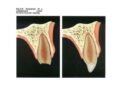 Gambaran fraktur mahkota komplikata dengan paparan pulpa sebelum dan sesudah dilakukan perawatan direct pulp capping untuk mempertahankan vitalitas pulpa (Sumber: J.O Andreasen Essentitals of Traumatic Injuries to the Teeth)
