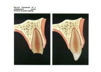 Gambaran fraktur mahkota komplikata dengan paparan pulpa sebelum dan sesudah dilakukan perawatan direct pulp capping untuk mempertahankan vitalitas pulpa (Sumber: J.O Andreasen Essentitals of Traumatic Injuries to the Teeth)
