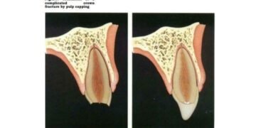 Gambaran fraktur mahkota komplikata dengan paparan pulpa sebelum dan sesudah dilakukan perawatan direct pulp capping untuk mempertahankan vitalitas pulpa (Sumber: J.O Andreasen Essentitals of Traumatic Injuries to the Teeth)