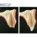 Gambaran fraktur mahkota komplikata dengan paparan pulpa sebelum dan sesudah dilakukan perawatan direct pulp capping untuk mempertahankan vitalitas pulpa (Sumber: J.O Andreasen Essentitals of Traumatic Injuries to the Teeth)