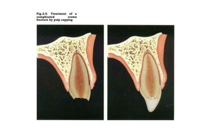 Jangan Anggap Sepele Gigi Patah: Kapan Harus Ditangani oleh Dokter Gigi Bedah Mulut? 46 Gambaran fraktur mahkota komplikata dengan paparan pulpa sebelum dan sesudah dilakukan perawatan direct pulp capping untuk mempertahankan vitalitas pulpa (Sumber: J.O Andreasen Essentitals of Traumatic Injuries to the Teeth)